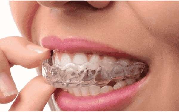 Invisible teeth aligners dentist in tirupur