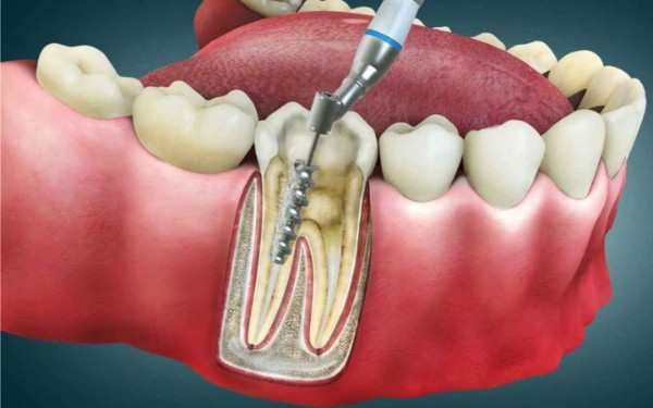 Root Canal Treatment in Tirupur